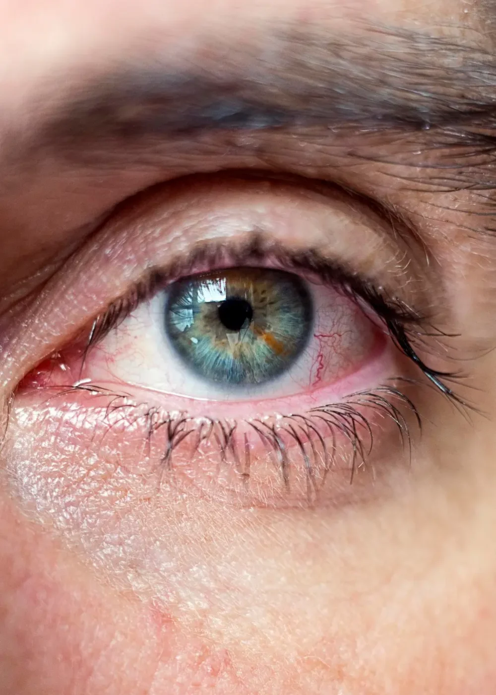 Ojo seco